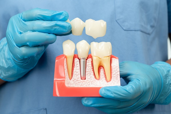 How Is A Dental Implant Placed?